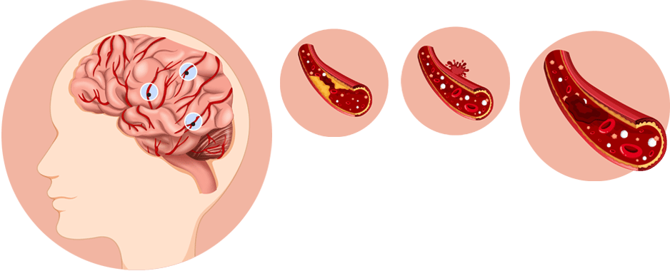 What is meningococcal disease?